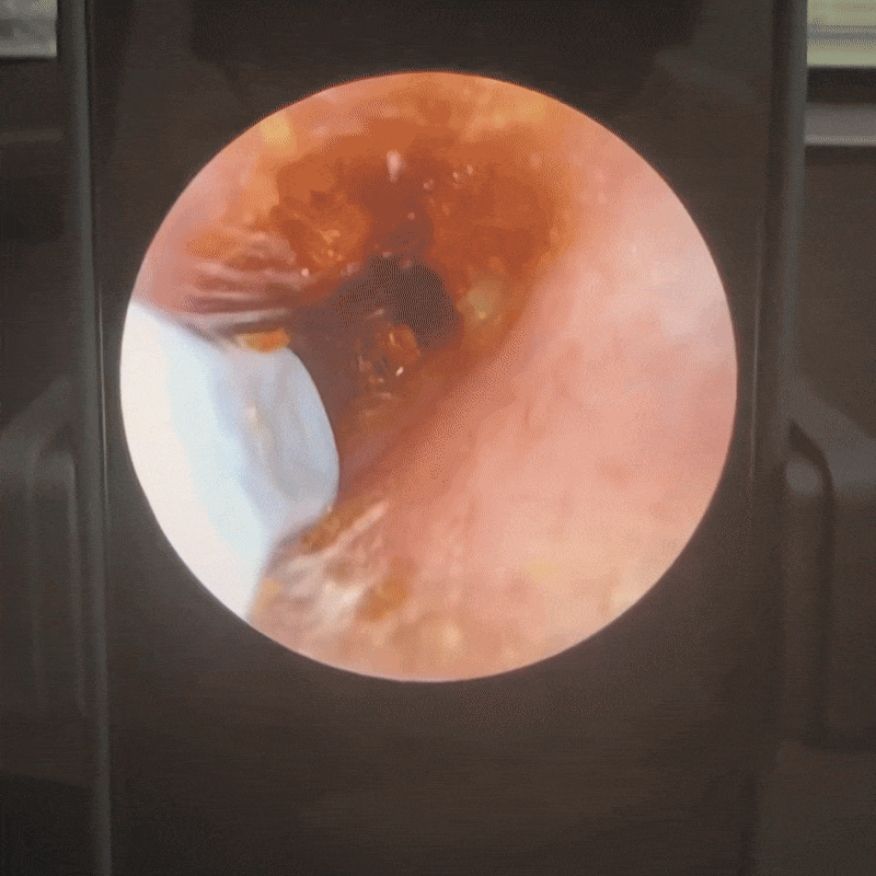 Zentara® VisioEar